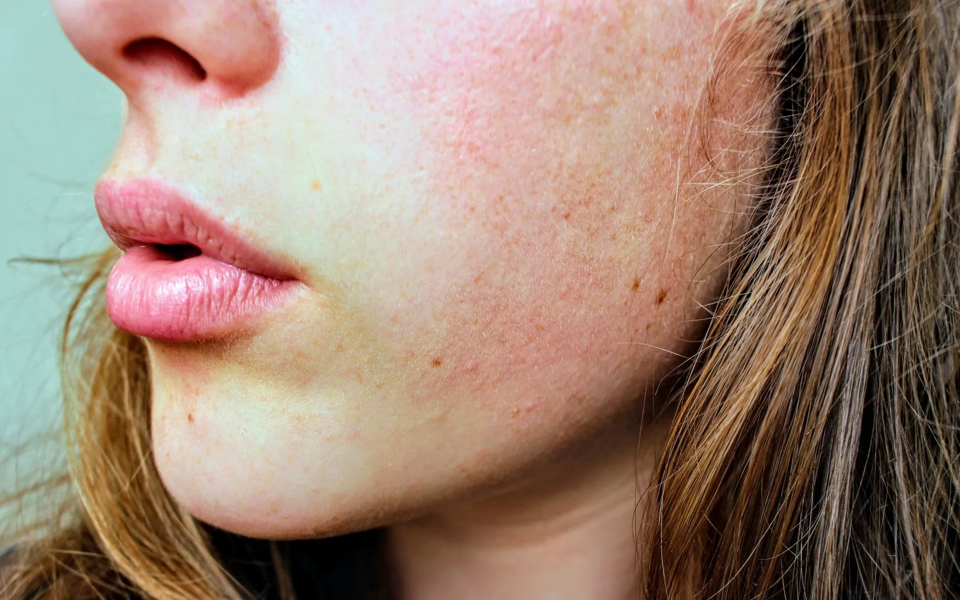 Rosacée : quelle routine de soins contre les poussées ?